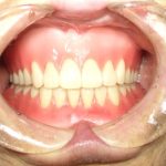 入れ歯は仮合わせで歯並びを確認してもらいます。