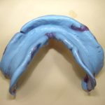 入れ歯の精密な型取り。