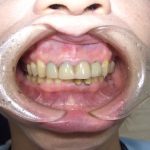 歯周病の対応について。