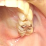 虫歯の判定について