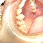 歯のコンポジットレジン修復について。