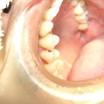 歯のコンポジットレジン修復について