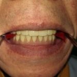 総入れ歯の咬み合わせの調整について。