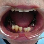 抜歯と同時の入れ歯セットについて。