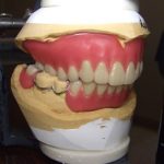 入れ歯の仮合わせについて