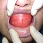 総入れ歯の咬み合わせの高さについて。