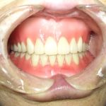 要介護者の入れ歯治療に思うこと。
