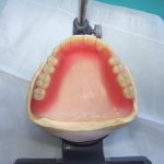 総入れ歯の人工歯配列について。