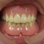 総入れ歯の使用法と管理について。