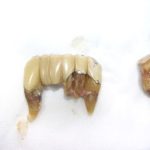 歯の保存と抜歯について