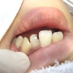 虫歯の治療について。