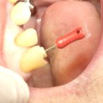 歯の根管治療について。