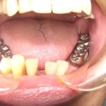 歯の欠損に対する処置について