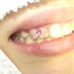 歯間部の虫歯治療。