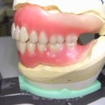 入れ歯のセット時に思うこと