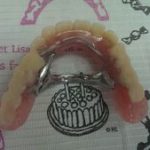 入れ歯の修理について