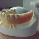 少数歯欠損には、ノンクラスプ入れ歯が適応だったりします。