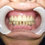 総入れ歯の難症例。