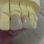 歯科材料の材質的な問題。