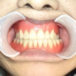 総入れ歯の咬合の狂いについて。