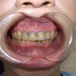 歯科健診について。