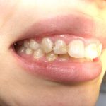 虫歯の好発部位について。