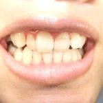 ホームホワイトニングのやり方と効果