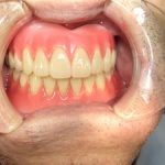 総入れ歯の人の咬み方の注意点。