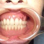 入れ歯があるなら、使いましょう