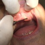 総入れ歯製作時に問題となるブヨブヨの粘膜。