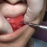 総入れ歯の咬み合わせを決める装置