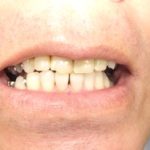 歯を保存するための、歯科健診。