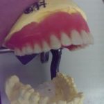 シングルデンチャーは難しい