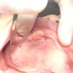 入れ歯を入れる前の粘膜調整。