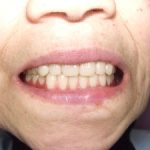 総入れ歯の安定を目指して