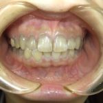 歯を残すための定期健診とクリーニングをしましょう。