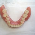 使用中の総入れ歯の咬合調整について。