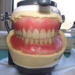 入れ歯のための人工歯の選択。