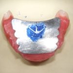 総入れ歯の咬み合わせの位置設定。