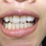 患者さんが持つ入れ歯への抵抗感。