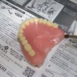 総入れ歯製作のための前処置。