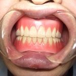 入れ歯の適合が良くないと。。。