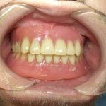 総入れ歯の型取りと咬合の付与について。