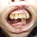 適切な咬み合わせによる体調の変化。