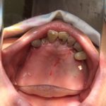 歯が欠損すると歯茎は痩せます。