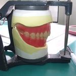 総入れ歯の咬合関係。
