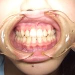 入れ歯にならないために。。。