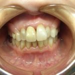ノンクラスプ入れ歯は目立たないですね。