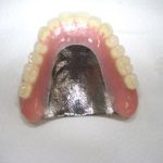 チタン床義歯の強度について。