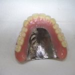 自由診療で作る金属床入れ歯はメリットが多いですよ。